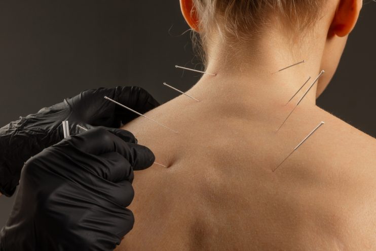 Close-up,Of,Acupuncture,Therapy,On,Upper,Back,Performed,By,Gloved