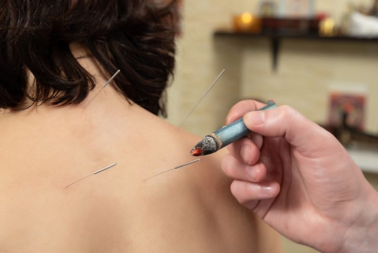 Tibetan,Medicine.,Acupuncture,,Warming,Up