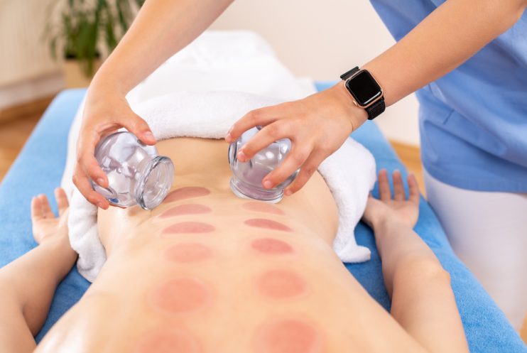 Woman,Getting,Cupping,Treatment,At,A,Spa.,Cupping,Therapy.,Treatment