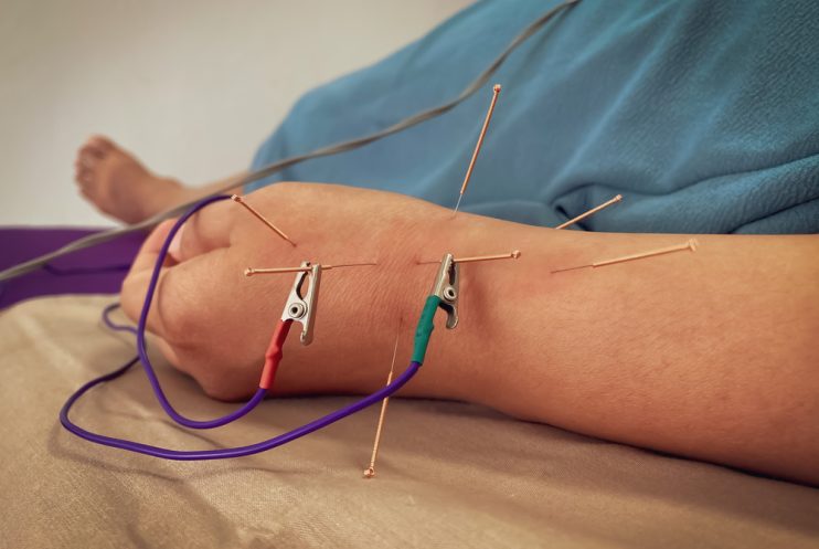 Treating,Wrist,Pain,With,Gentle,Acupuncture,And,Electrical,Stimulation.