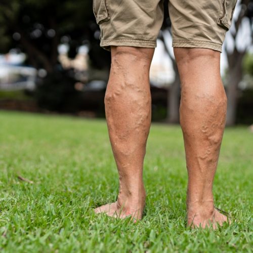 Elderly,Man's,Bare,Legs,With,Varicose,Veins,In,A,Park,