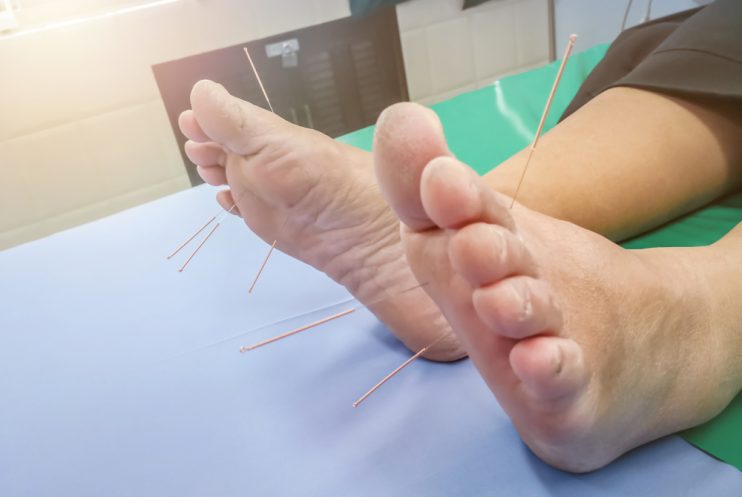 Acupuncture,On,The,Feet