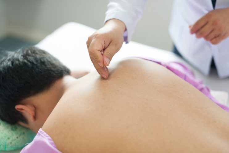 Acupuncture,Chinese,Traditional,Treatment,For,Back,Pain