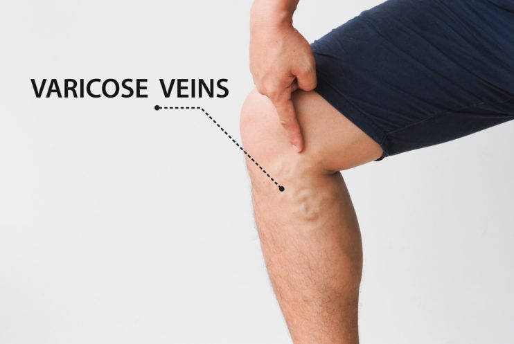 Varicose,Veins,On,The,Legs,Of,Men